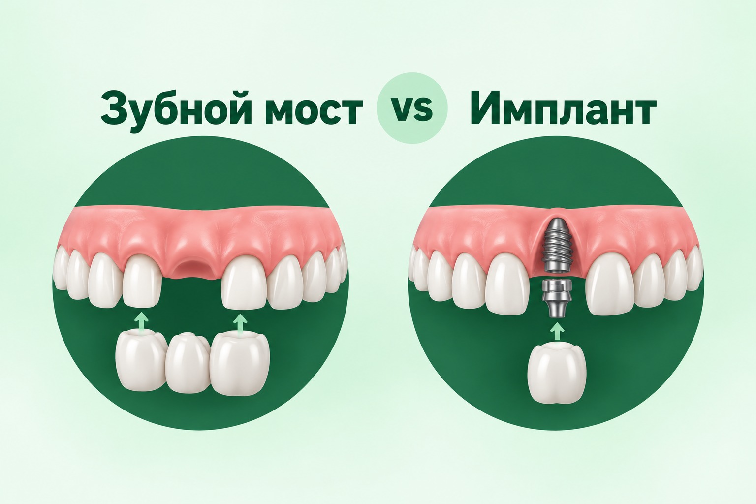 Сравнение: зубной мост опирается на обточенные соседние зубы, имплант вживляется в кость на место корня