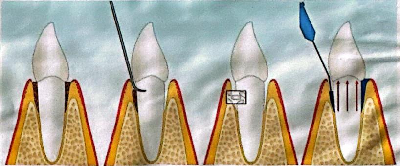 НОВАЯ ЛАЗЕРНАЯ ТЕХНОЛОГИЯ