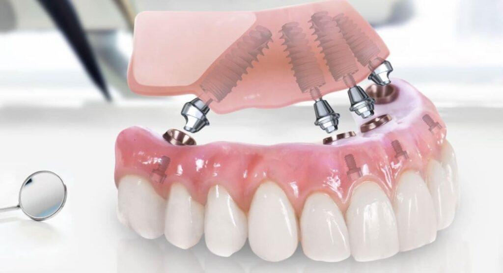 Имплантация зубов