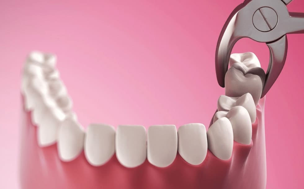 Когда удалять зуб мудрости