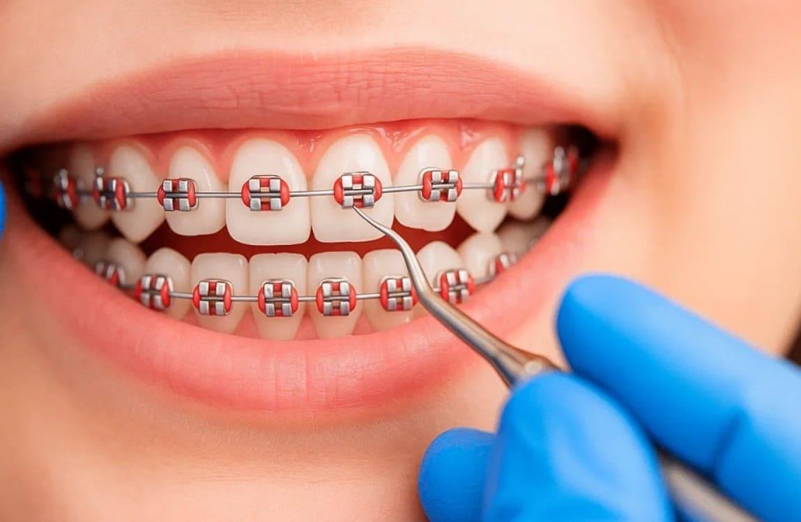 Как ухаживать за брекетами